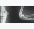 The treatment of Isolated fractures of сapitulum humeri  in adult patients using microscrews