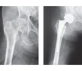 The main criteria for predicting dislocation of the endoprosthesis head  in patients with femoral neck fractures after unipolar hip arthroplasty