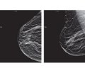 Сучасні методи медичної візуалізації в діагностиці  й скринінгу раку молочної залози