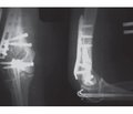 Surgical treatment of fractures of the humerus and the biological aspects of osteosynthesis
