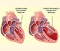 Cognitive impairment in patients with chronic heart failure  and reduced left ventricular ejection fraction on the background  of hypertension