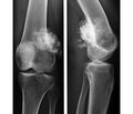 Assessment of effectiveness and complications of neoadjuvant multiagent chemotherapy  in complex treatment of patients with osteosarcoma in long bones
