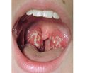Features of acute tonsillitis in the servicemen depending on the season