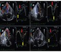 Role of speckle tracking echocardiography in the diagnosis and treatment of cardiovascular diseases