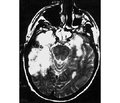 Zoster encephalitis with epileptic seizures:clinical picture, features of diagnosis and treatment