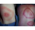 Multiple organ lesions in Lyme disease