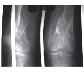 Tactical and technological features of the treatment for damages to the distal metaepiphysis  of the femur
