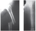 Anonymous cancer metastases in the long bones of the limbs:  approaches to the screening and treatment