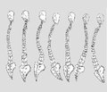 Peculiarities muscle imbalance in patients with Scheuermann’s disease with different variants of the spine sagittal contour