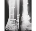 Closed minimally invasive osteosynthesis of metaepiphyseal fractures of distal tibial bones