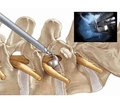 Analysis of the results of microsurgical lumbar discectomy, characteristics of complications in the early and remote period: the current state of the issue (review of literature)