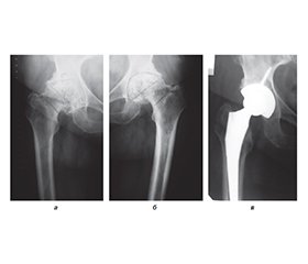 Сучасний підхід до профілактики венозних тромбоемболічних ускладнень у хворих до та після операції ендопротезування кульшового суглоб