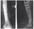 Treatment of diaphyseal fractures of the humerus using locking intramedullary nailing in the conditions of regional intensive care hospital of Mariupol 