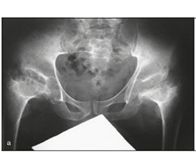 Клініко-рентгенологічні показники при остеоартрозі колінних та кульшових суглобів на ґрунті спондилоепіфізарної дисплазії