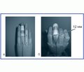 Біомеханічні особливості функціонування пальців кистей в умовах деформації при застарілих ушкодженнях сухожилків розгиначів