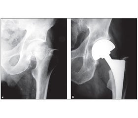 Surgical Treatment of Medial Fractures of the Femoral Neck