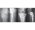 Досвід оперативного лікування переломів проксимального метаепіфіза великогомілкової кістки у хворих із політравмою