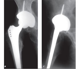 Method of Acetabular Cup Insertion in Total Hip Arthroplasty in Conditions of Osteoporosis due to Trauma