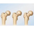 The modern state of the treatment for periprosthetic fractures of the femur