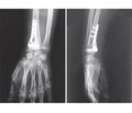 Own experience of treatment of distal metaphyseal forearm fracture
