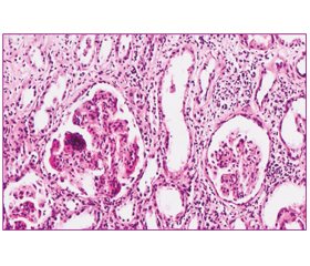 ВИЧ-ассоциированная нефропатия: клинико-морфологические особенности (собственные наблюдения)