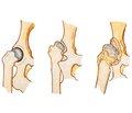 The results of total arthroplasty for developmental dysplasia of the hip