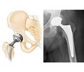 The influence of changes in the length of hip abductor moment arm after hip replacement on the features of patients’ walking (analytical review of literature)