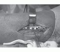 Використання напруженої петлі при хірургічному лікуванні переломів кісточок із пошкодженням міжгомілкового синдесмозу