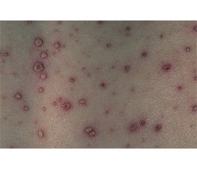 Features of varicella in children with oncohematological diseases