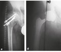 Results of Clinical Application of Acetabular Component with Porous Tantalum Surface in Case of Acetabulum Defects and Osteoporosis