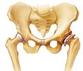 Hip osteoarthritis. Technical means of diagnosis. Analytical review of the literature. Part II