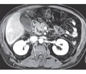 Hemosuccus pancreaticus як рідкісна причина шлунково-кишкової кровотечі