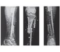 The reconstruction of complex cases of septic non-union of the tibia