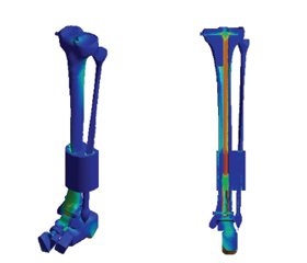 Mathematical modeling of the osteosynthesis of the lower leg bones using a titanium mesh for their congenital pseudoarthrosis in the lower third