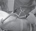Micro-Hip® — an Advanced Technique for Minimally Invasive Total Hip Arthroplasty for Clinical Routine