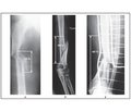 Comminuted Shaft Fractures and Their Treatment