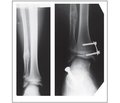 Calcaneo-stop in the Treatment of Flexible Flatfoot in Children and Adolescents: Indications and Surgical Technique