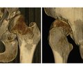 Patterns of acetabular sectoral deficiency in hip dysplasia