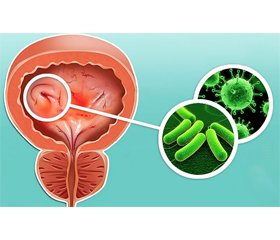 Унікальні переваги препарату ЦИСТО-АУРИН® у лікуванні інфекцій сечовивідних шляхів