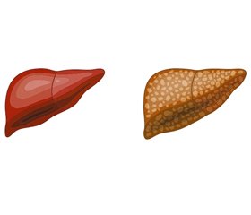 Неалкогольна жирова хвороба печінки: час для змін