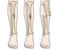 Treatment of diaphyseal fractures of the bones of the lower extremity by using BIOS method in polytrauma