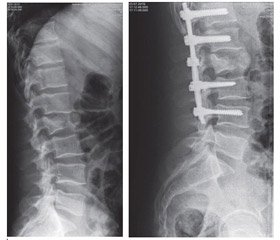 Results of the vertebral body regeneration during surgical treatment of burst fractures  of the thoracic and lumbar spine