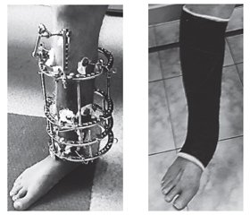 Bilocal osteosynthesis of the tibia with ring fixators in the treatment of nonunions