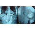 Хірургічна корекція неспроможності фізіологічної кардії при грижах стравохідного отвору діафрагми