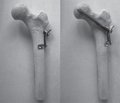 Особливості малоконтактного багатоплощинного остеосинтезу переломів шийки стегнової кістки