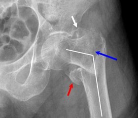 Analysis of hospital mortality in patients with proximal femoral fractures