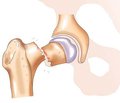 Профилактика тромбоэмболии при лечении переломов проксимального отдела бедренной кости в условиях районного травматологического отделения