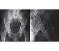 Pelvis apofysial avulsion fractures: three amateur football player case reports and a review of the literature