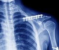 Clavicle fracture fixations in patients with flail chest and polytrauma