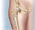 Особенности остеосинтеза переломов шейки бедренной кости в молодом возрасте  